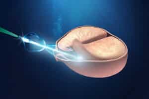 Cirugi de prostata con laser