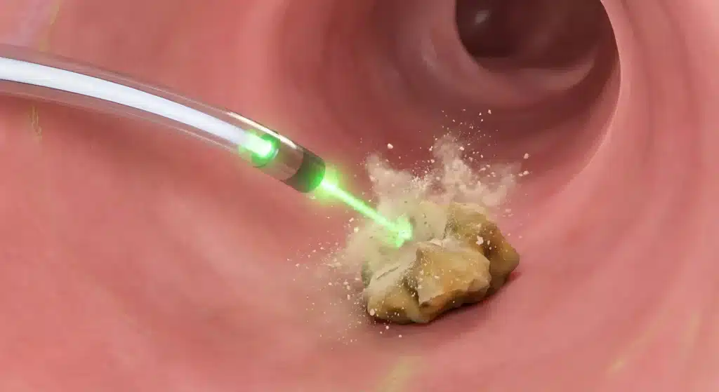 Representación médica de un procedimiento de litotricia con láser Ho:YAG pulverizando un cálculo renal dentro del uréter, un tratamiento avanzado para piedras en el riñón disponible en Costa Rica